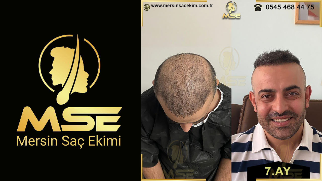 MERSİN SAÇ EKİMİ